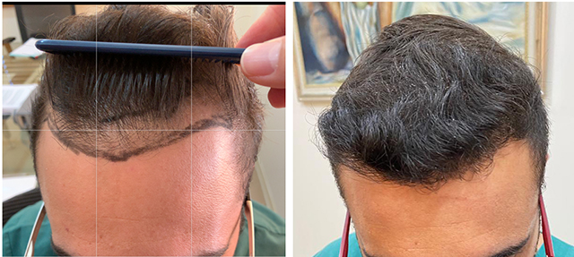 Hairline Result – 0 to 11 Months – 2100 FUE Grafts 