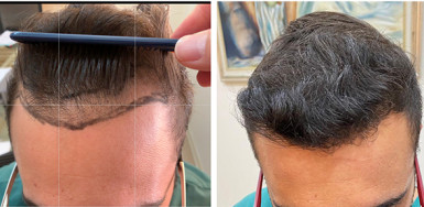 Hairline Result – 0 to 11 Months – 2100 FUE Grafts 