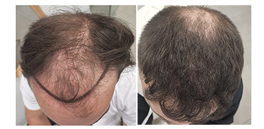 Result of FUE1 to front and top – Post op of Crown  - Total 6055 Grafts – HDC Hair Clinic – Dr Christina