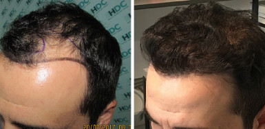 Hair Transplant Result for 2900 grafts – 15 months after – Hairline and behind 