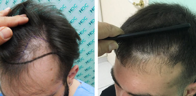Before and after 2500 grafts – Hair transplant on Temples – Dr Christina Vrionidou 
