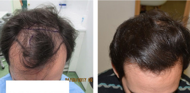 Before and 16 months after Hair Transplant – 2100 FUE Grafts 