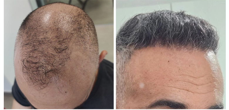 FUE repair Result after 6026 Grafts in two Sessions – Dr Maras