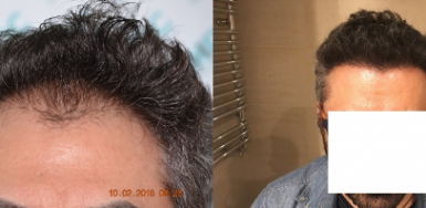 Hair transplant result – FUE 2700 – Class 3 – HDC Hair Clinic