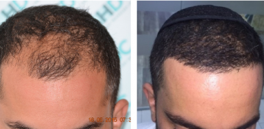 Hair transplant result – FUE 2680 – Class 3 – HDC Hair Clinic