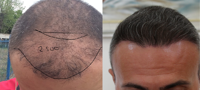 Hair Transplant Result for 2400 FUE –  years after