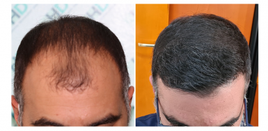 3650 Grafts FUE Result – NW 3-4 - 1 year After