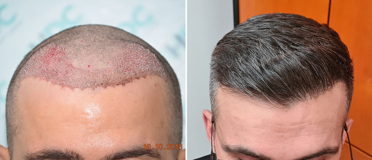 Hairline and crown - 4000 FUE Grafts – Dr Christina – HDC Hair Clinic