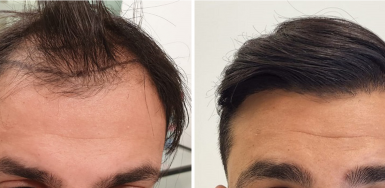 Hair Transplant Results / Before & After Photos - HDC Hair Clinic