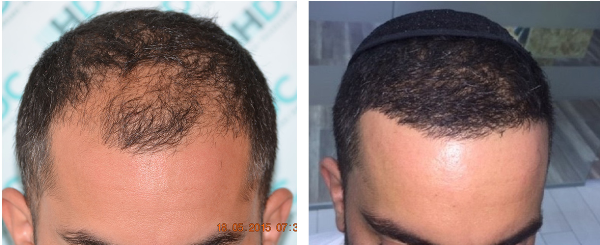 Hair transplant result – FUE 2680 – Class 3 – HDC Hair Clinic