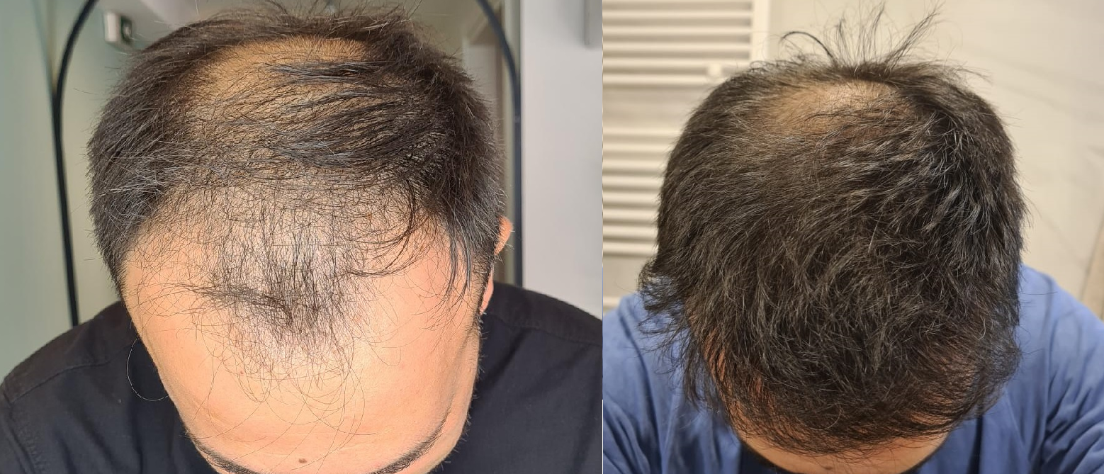 Hair Transplant Result - 0 to 7 months for 4350 FUE – HDC Hair Clinic with  Dr Christina