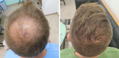 Crown FUE Result – 2900 grafts – 1 Year after 