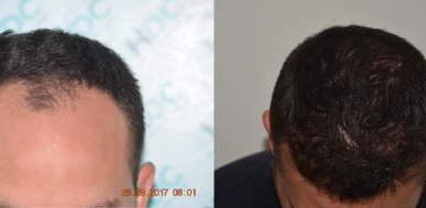 NW3 Hair Transplant Result – 2900 FUE grafts 