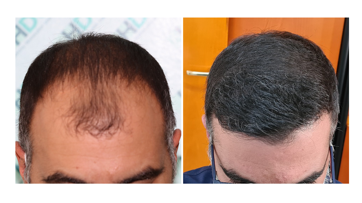3650 Grafts FUE Result – NW 3-4 - 1 year After