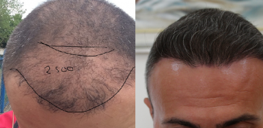 Hair Transplant Result for 2400 FUE – 3.5 years after 
