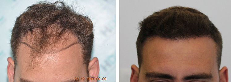 FUE Result for 3000 grafts – 0 to 9 months – NW3