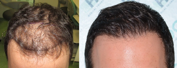 Hair Transplant Result - 2900 Grafts FUE - NW3
