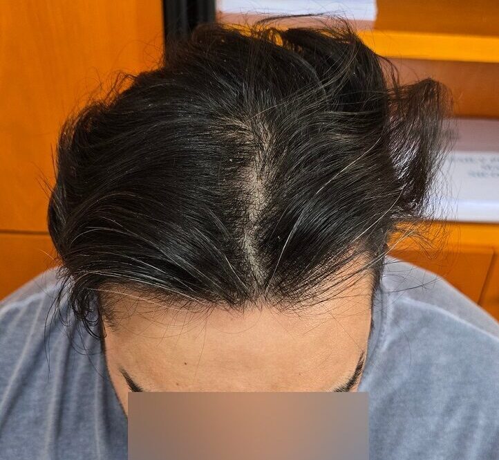 After 4500 Grafts top