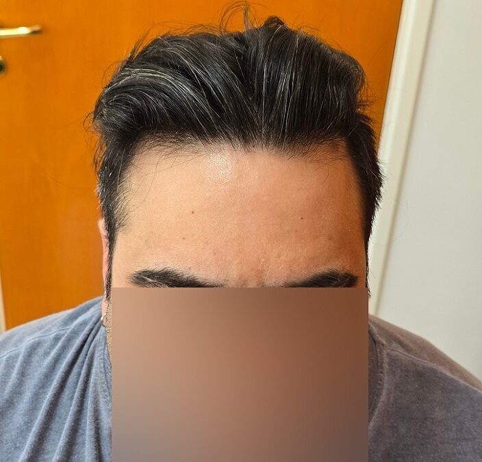 After Front