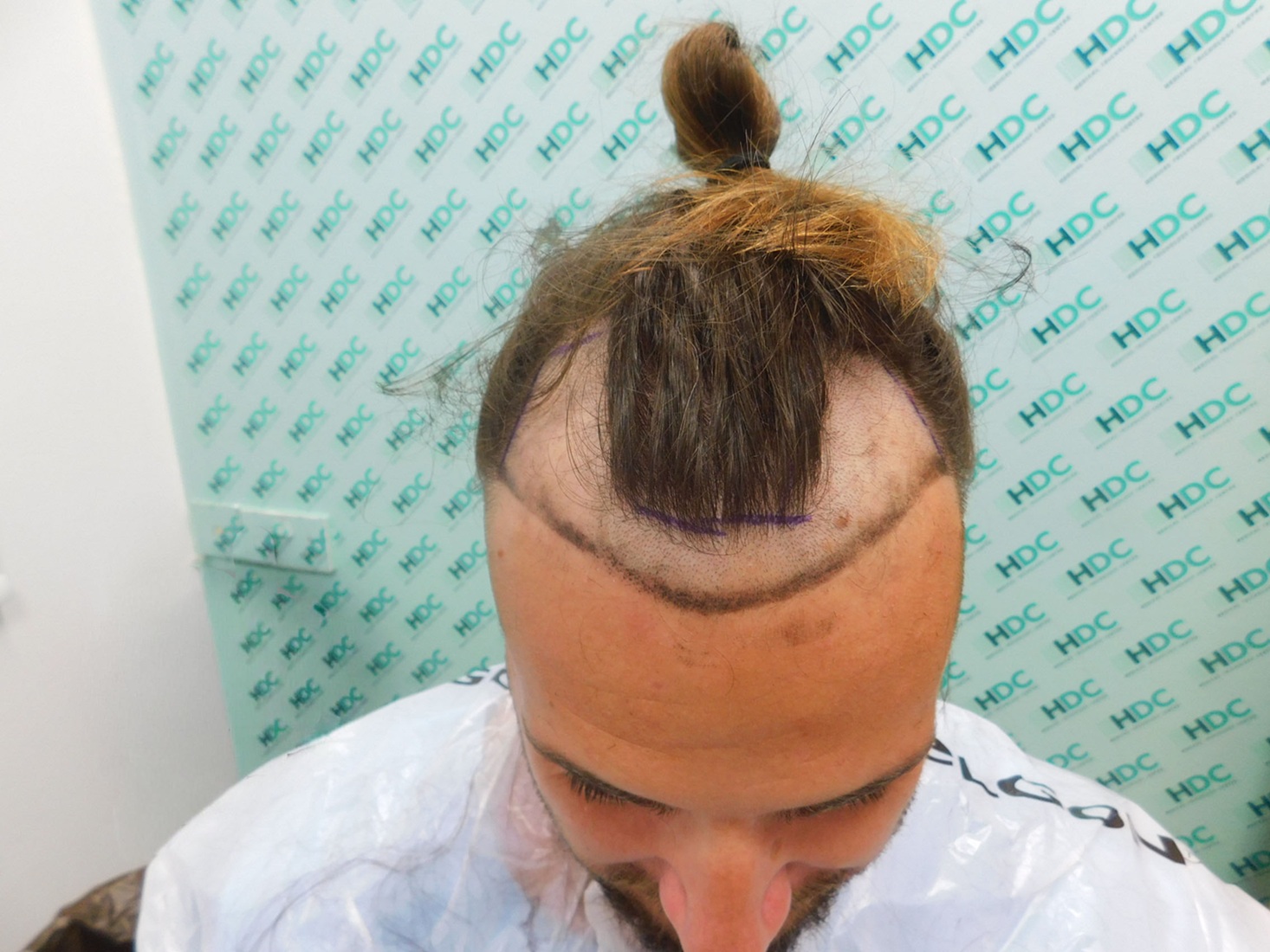 3. before with design and shaved hairline recipient