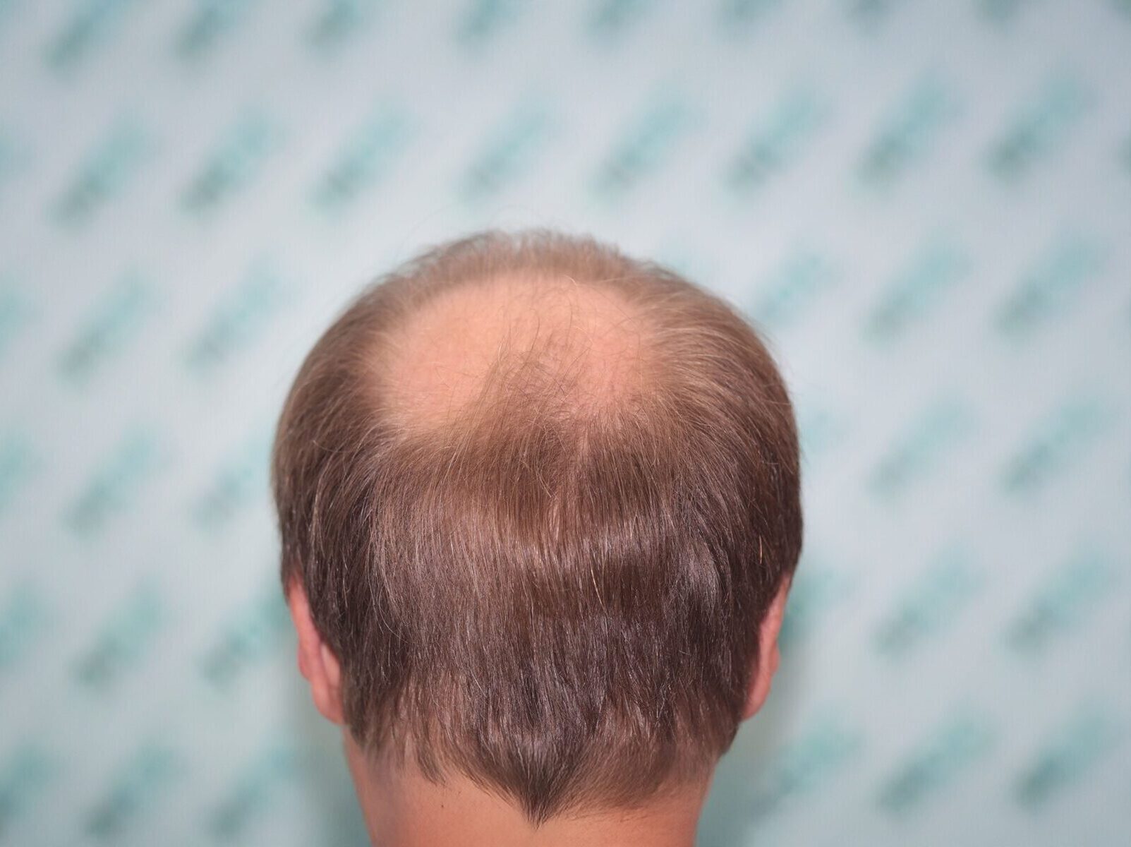 3. thin donor hair(2)