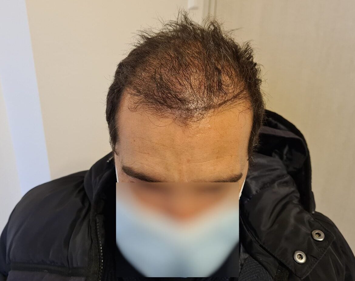 Before FUE Wavy Hair Result – 7000 Grafts