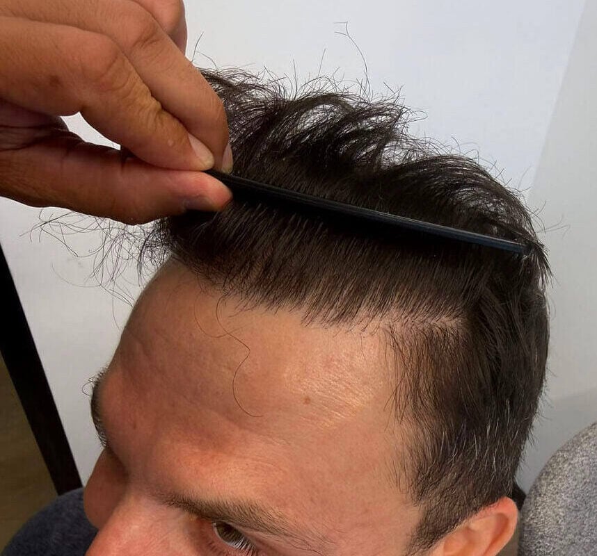 5. hairline result left 06 09 2026 17 20 30(1)
