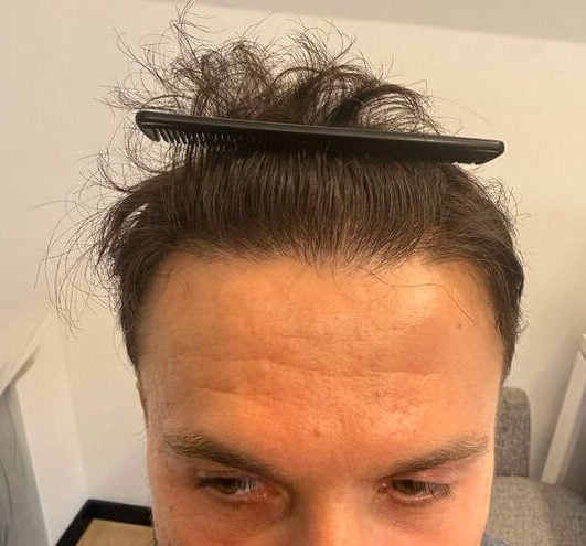 6. hairline result front 06 09 2026 16 59 24(1)