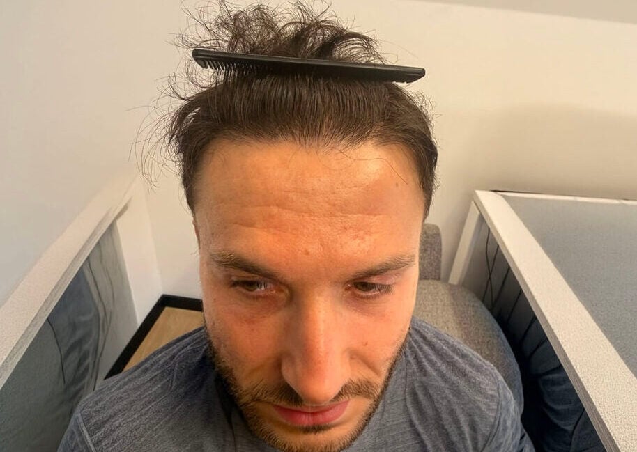 6. hairline result front 06 09 2026 16 59 24(1)