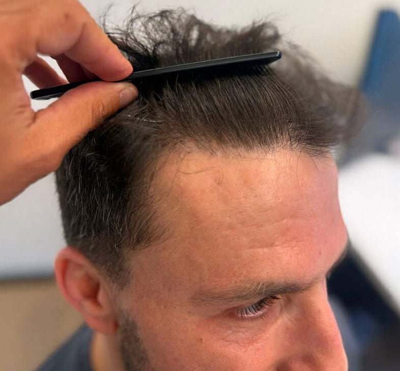 7. hairline result right 06 09 2026 17 08 47(1)